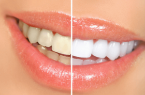 LED TEETH WHITENING ENFIELD